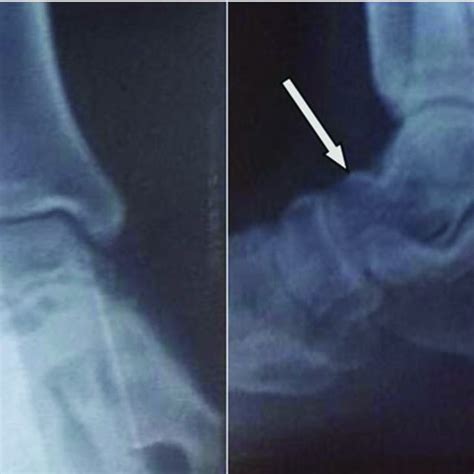 Ap And Lateral View Of Right Ankle Showing Lytic Lesion With Sclerotic