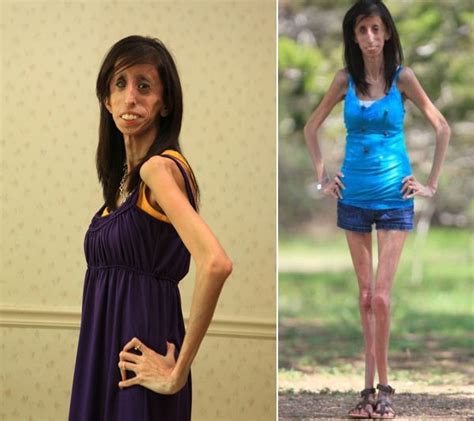Thenextpicture Skinniest Person In The World Lizzie Velasquez