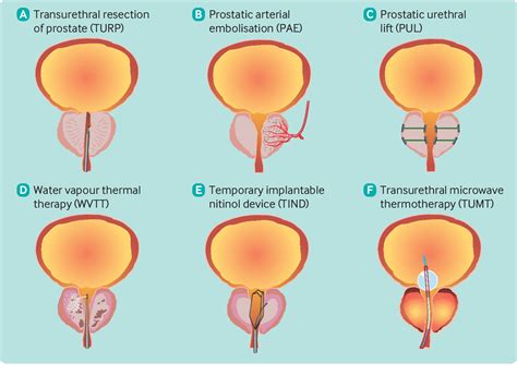 What Is The Role Of Minimally Invasive Surgical Treatments For Benign Prostatic Enlargement