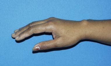Ganglion Cyst Clinical Presentation History And Physical Examination