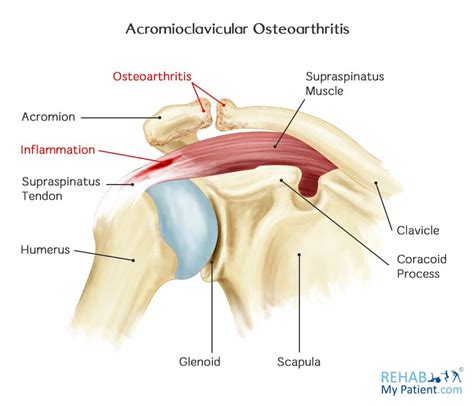 Acromioclavicular Joint Arthritis Treatment Quotes Resume