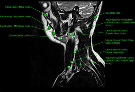 The lymph glands of the neck—the lymph glands of the neck include the following groups the inferior deep cervical glands drain the back of the scalp and neck, the superficial pectoral region, part of the arm (see page 701), and, occasionally, part of the superior. pkikcaba: nodes in neck