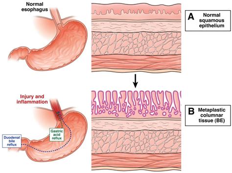Barretts Esophagus Explained And Shown Using Medical Animation Still