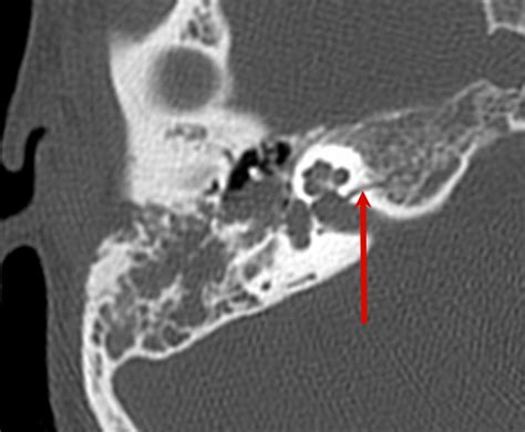 Temporal Bone Trauma Axial Ct Scan Shows Fracture Line Crossing
