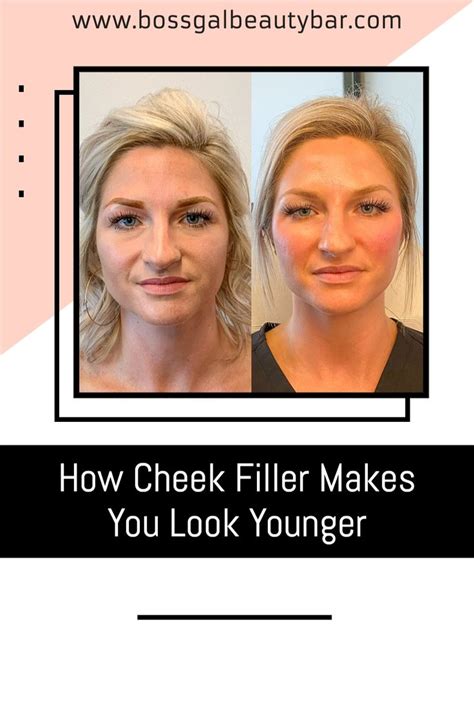 Cheek Filler Makes You Look Younger In 2021 Cheek Fillers Beauty Bar