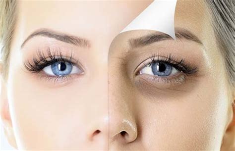 Göz Altı Torbaları ve Morlukları İçin Evde Uygulayabileceğiniz 8 Doğal