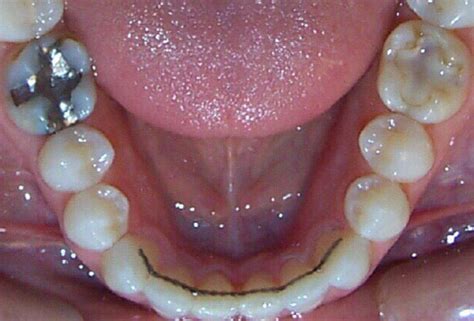 Lingual Braces Inside Braces Ortho Orthodontics Toronto