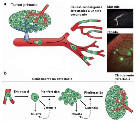 10 Formación De Metástasis A Través Del Sistema Sanguíneo A Tumor