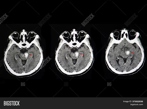 Ct Scan Brain Patient Image And Photo Free Trial Bigstock