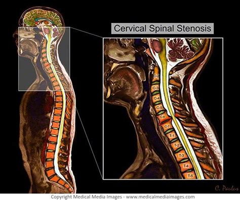 A Color MRI Showing Cervical Spinal Stenosis A Novel Advanced Visual