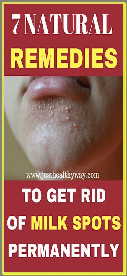 7 Remedies To Get Rid Of Milk Spots Naturally Skin Care Remedies