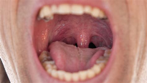 Promising New Hpv Saliva Test Detects Early Stage Throat Cancer