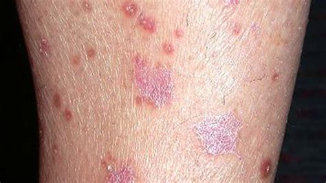 Psoriasis Bumps On Skin