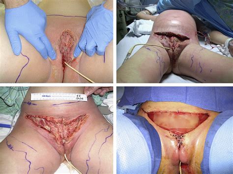 Necrotizing Fasciitis Surgery SexiezPix Web Porn