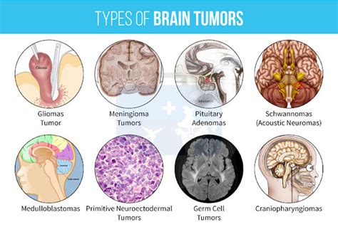 Types Of Brain Stem Tumors