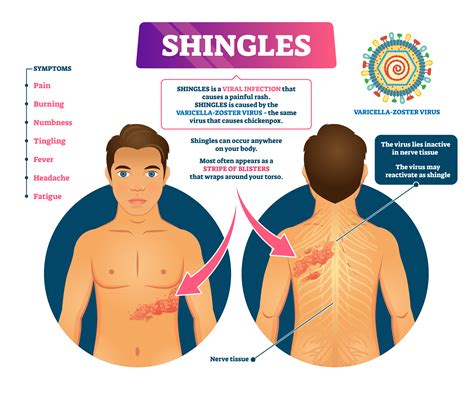 Shingles and Shingrix, Everything People Need to Know - Lompoc Valley ...