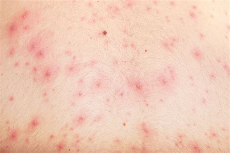 Chickenpox Description Cause And Symptoms Britannica