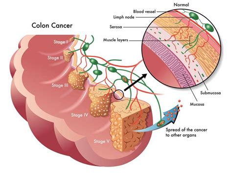 Then i saw the news that colon cancer, though declining in older people, was on the rise in those aged 40 to 49. Here Is How This 70-Year-Old Man Naturally Cured His Late ...