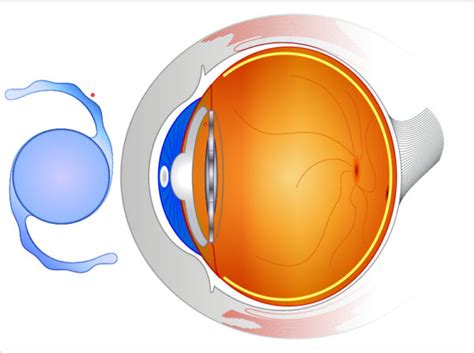 Cataract Surgery Springfield Toric Lens Implants Branson