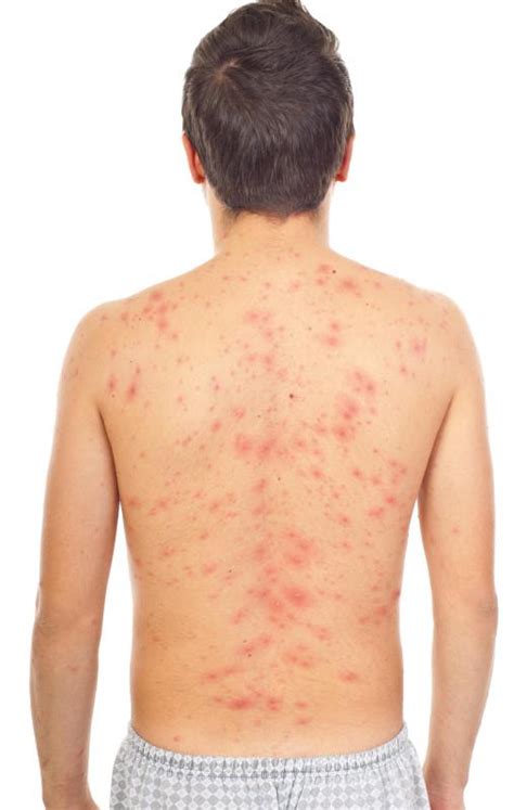How Do I Tell The Difference Between Skin Rashes And Hives