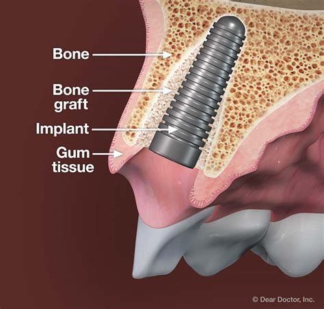 Immediate Dental Implants Regenerating Bone Tissue