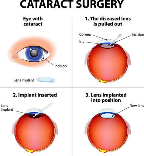 Cataracts develop when the clear lens of your eye becomes cloudy, which causes symptoms like blurry vision. Cataract Surgery Price in India - Best Hospitals in India