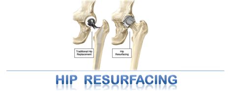 Hip Resurfacing Surgery At Best Price In Karnal Id 7526031191