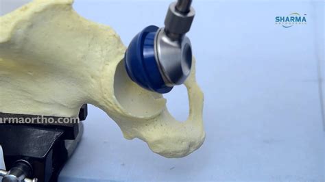 Total Hip Replacement System- Cemented - YouTube