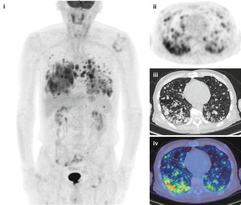 Clinical Applications Of Petct In Oncology Radiology Key