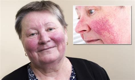 Rosacea Or Excessive Blood Vessels Whats Causing Your Red Cheeks How