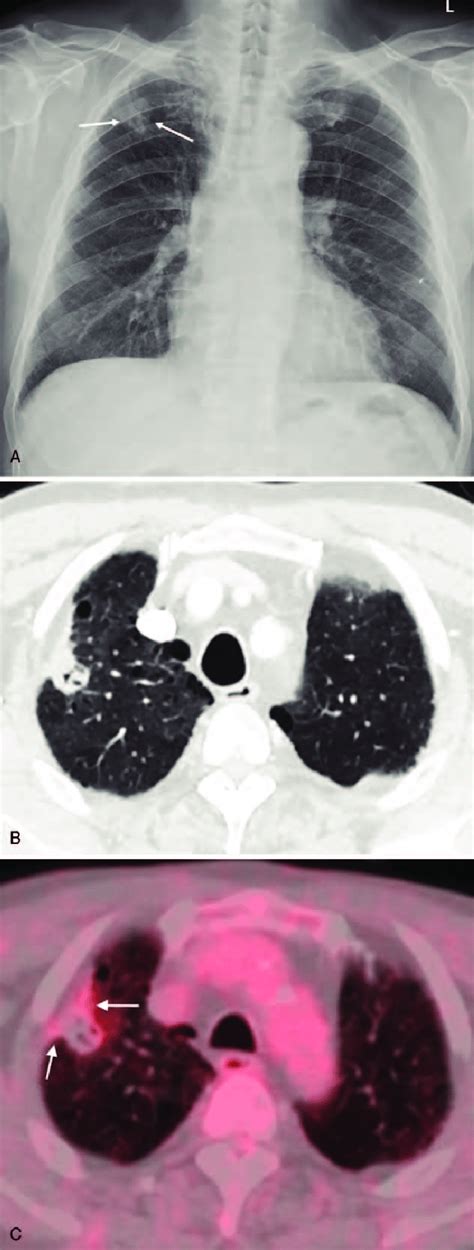 A 73 Year Old Male Patient Presented With Incidental Lung Nodule A
