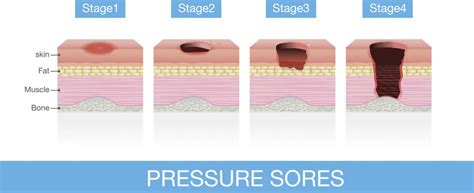 Bed Sores Treatment Stages And Prevention