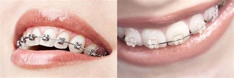 Dental Braces San Antonio Tx Hulme Orthodontics Clear Braces