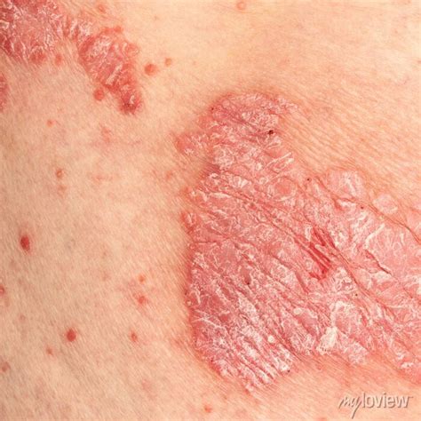Psoriasis Vulgaris Detail Of Psoriatic Skin Disease An Autoimmune Skin