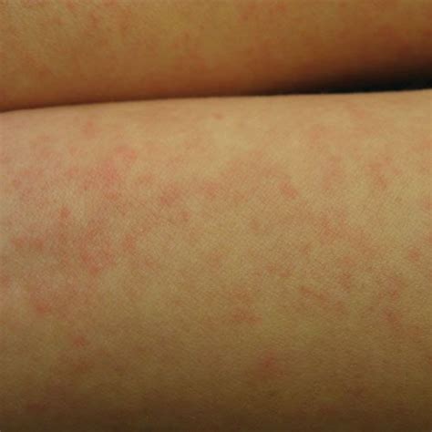 ¿cuál es la diferencia entre hives y rash? Gallery of Hives Pictures for Identifying Rashes