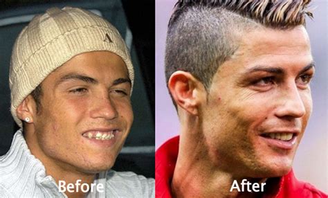 Cristiano Ronaldo Plastic Surgery Before And After Latest Plastic