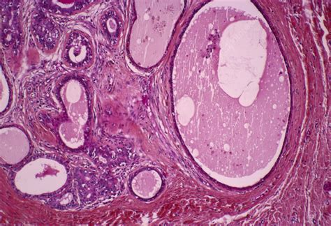 Breast Hypertrophy Light Micrograph Stock Image M