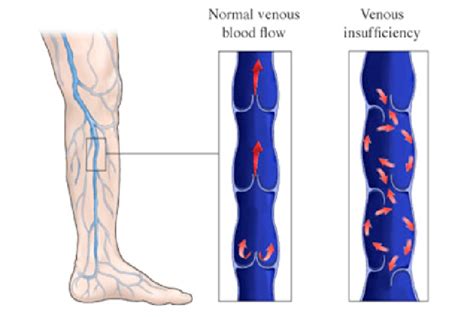 Venous Insufficiency Florida Cardiology Pa