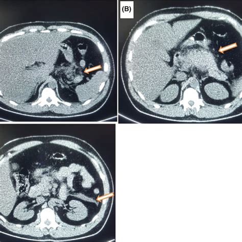 Ct Abdomen Axial View Showing Acute Necrotizing Pancreatitis Download