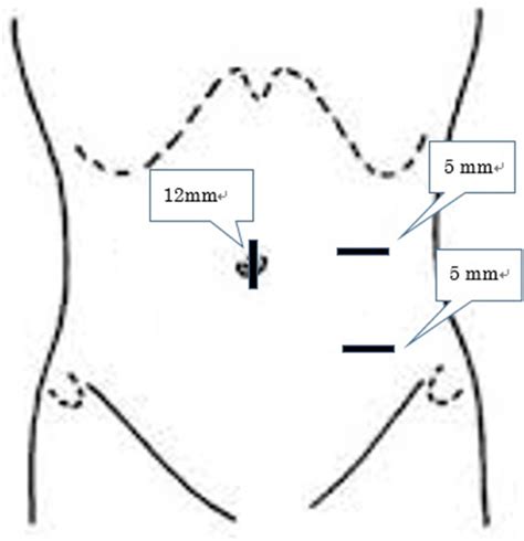 A Clinical Comparison Of Laparoscopic Versus Open Appendectomy For The