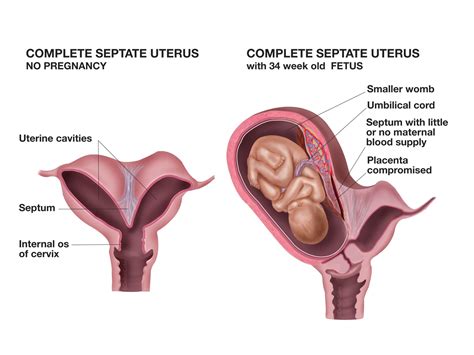 What Is A Septate Uterus Torontek