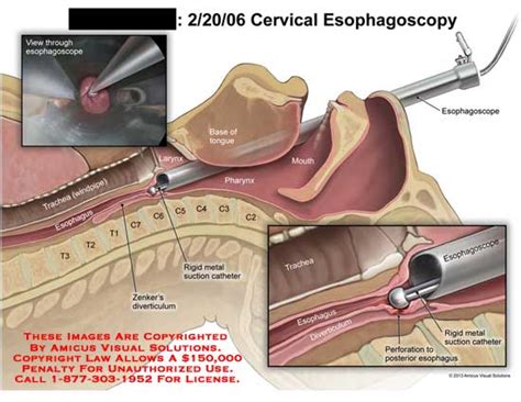 Amicus Illustration Of Amicussurgerycervicalesophagusesophagoscopy