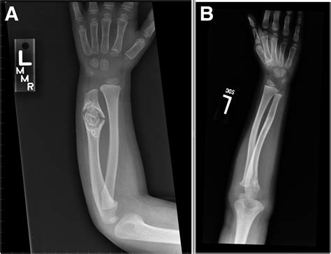 A 3 Year Old Boy With Swelling Of The Left Forearm Following An