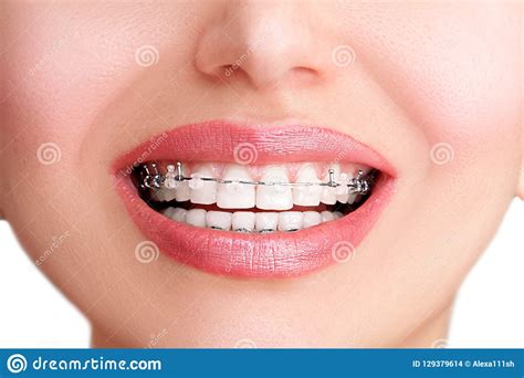 closeup ceramic and metal braces on teeth beautiful female smile with self ligating braces