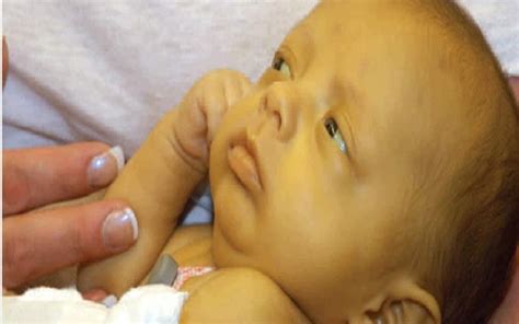 How Dangerous Is Jaundice For Newborn Babies