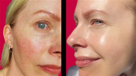 Rosacea How To Calm And Soothe Skin Youtube
