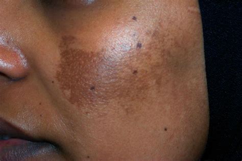 Causes Of Melasma And How To Treat It