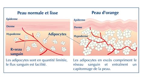 Quel Est Votre Type De Cellulite Massage à Domicile Entreprise Et