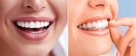 Invisalign Vs Veneers Which Is Best To Get A Straighter Smile
