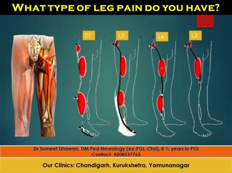 Back Pain And Leg Pain You May Have A Spine Problem